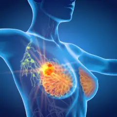 Model anatomiczny ukazujący skupisko komórek rakowych w piersi, które mogą powodować ból pod pachą.