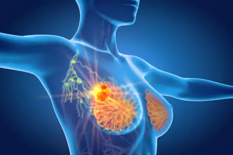 Model anatomiczny ukazujący skupisko komórek rakowych w piersi, które mogą powodować ból pod pachą.