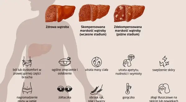 Objawy marskości wątroby: ból brzucha, zmęczenie, utrata masy ciała, żółtaczka, obrzęki, gorączka. Tak wygląda jak umiera się na marskość wątroby.