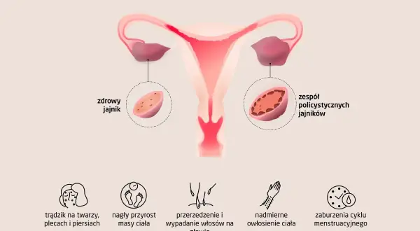 Ilustracja pokazuje budowę macicy i jajników, porównując zdrowy jajnik z tym dotkniętym PCOS. Widoczne są objawy: trądzik, przyrost masy ciała, wypadanie włosów, nadmierne owłosienie i zaburzenia cyklu.