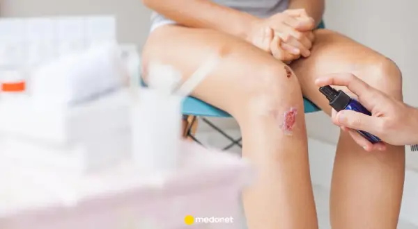 Lekarz aplikuje spray na otarcie na kolanie. Preparat, być może Solcoseryl, ma wspomóc gojenie.