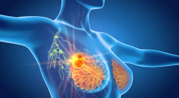 Model anatomiczny ukazujący skupisko komórek rakowych w piersi, które mogą powodować ból pod pachą.