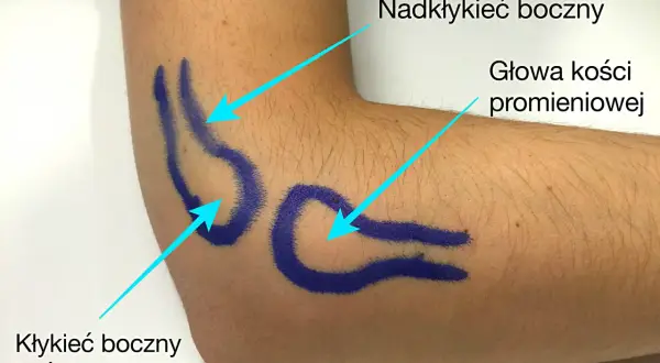 Zaznaczone niebieskim markerem okolice łokcia, wskazujące na łokieć tenisisty: nadkłykieć boczny, głowa kości promieniowej i kłykieć boczny kości ramiennej.