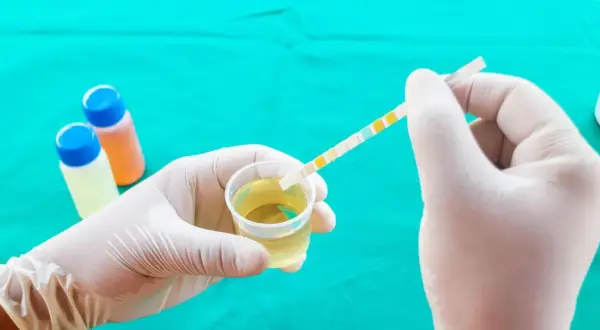 Ręka w rękawiczce zanurza pasek testowy w próbce moczu, badając potencjalne pasma śluzu.