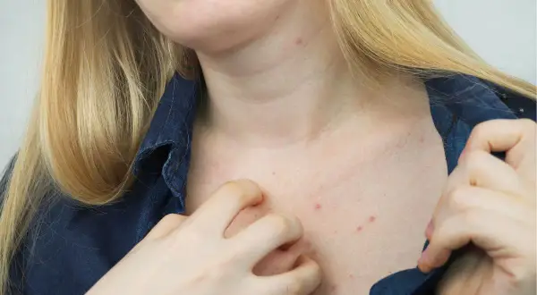Czerwone krostki i zaczerwienienie na dekolcie, wskazujące na świerzb objawy. Dłoń drapie swędzącą skórę.