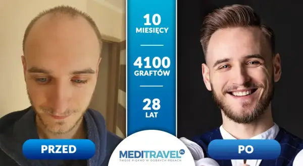 Przed i po przeszczepie włosów: 10 miesięcy, 4100 graftów, 28 lat. Zastanawiasz się, ile kosztuje przeszczep włosów?