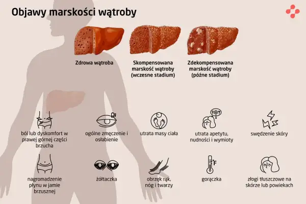 Objawy marskości wątroby: ból brzucha, zmęczenie, utrata masy ciała, żółtaczka, obrzęki, gorączka. Tak wygląda jak umiera się na marskość wątroby.