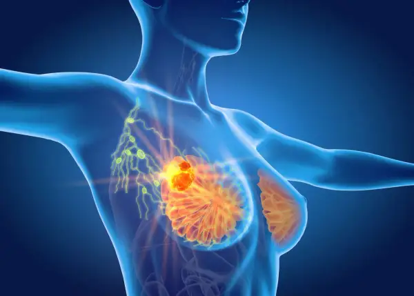 Model anatomiczny ukazujący skupisko komórek rakowych w piersi, które mogą powodować ból pod pachą.