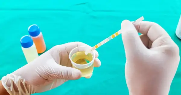 Ręka w rękawiczce zanurza pasek testowy w próbce moczu, badając potencjalne pasma śluzu.