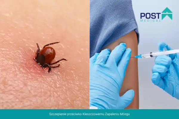 Kleszcz wgryza się w skórę, grożąc kleszczowym zapaleniem mózgu. Zaszczep się, by uniknąć zagrożenia.